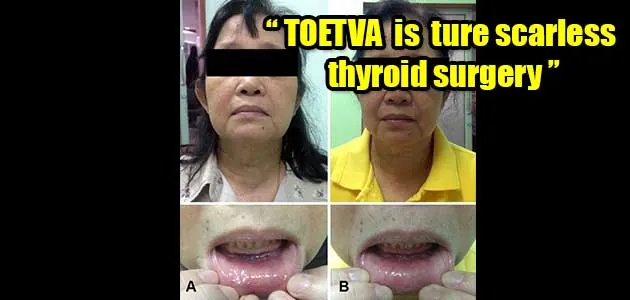 Scarless transoral endoscopic thyroidectomy